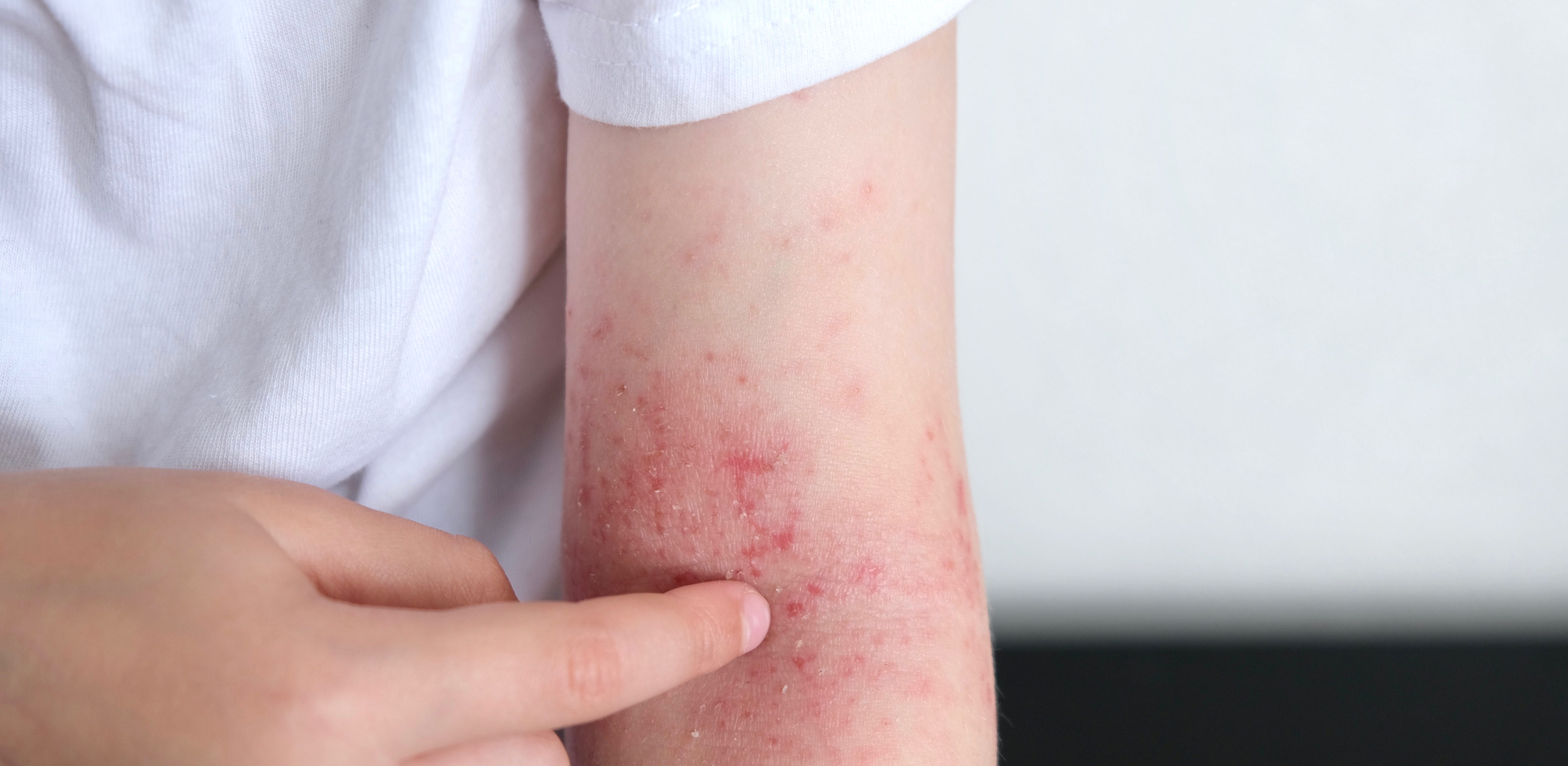 How to manage your eczema