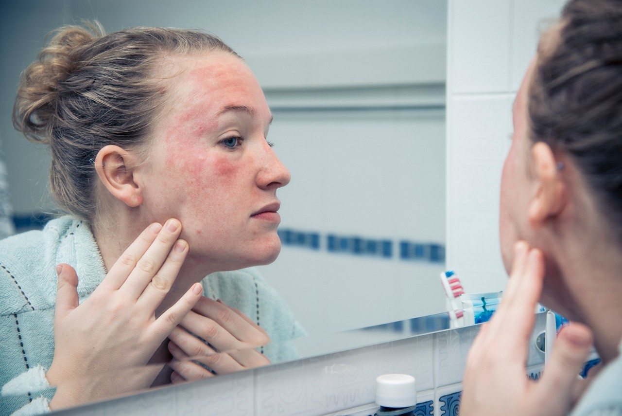 image of woman examining eczema rash in the mirror